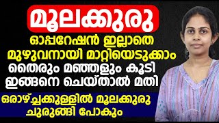 മൂലക്കുരു ഓപ്പറേഷൻ ഇല്ലാതെ മുഴുവനായി മാറ്റിയെടുക്കാം [upl. by Adnohsek256]