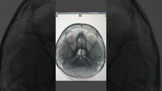 Xray PNS sinusitis anatomy radiologist medicaltest radiologycareer doctor radiology xray [upl. by Hekker903]