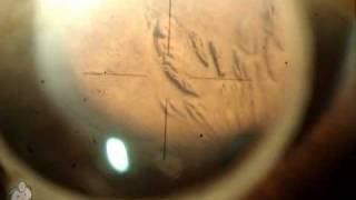 Laser peripheral iridotomy LPI [upl. by Enymsaj]