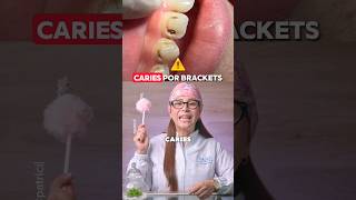 CARIES por BRACKETS 😰 ortodoncia dientes brackets caries curiosidades shorts [upl. by Pedroza]