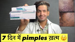 7 दिन में pimples ख़त्म 😲 Benzoyl peroxide gel 25  Benzoyl peroxide gel 25 how to use  Benzoyl [upl. by Orelie]