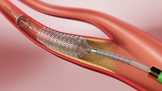 Carotid Angioplasty and Stenting 3D Animation [upl. by Siulesoj393]