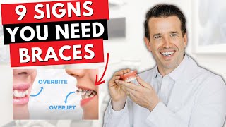 9 Signs you Need Braces  Overjet overbite crowding [upl. by Bodnar]