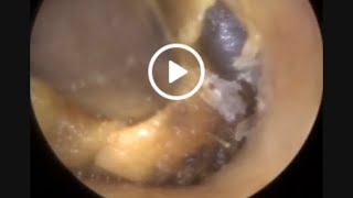 961  Super Itchy Ear Wax Removal [upl. by Aisekal]