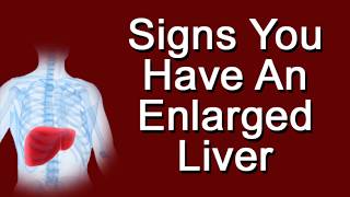 Signs You Have An Enlarged Liver [upl. by Neelrihs]