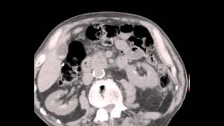 CT Abdomen Pelvis Renal Cysts Seminal Vesicle hemorrhage Discussion by Radiologist [upl. by Nawtna]