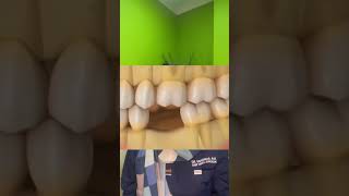 Save your teeth not just your smile Dental fillings vs extraction [upl. by Latta918]