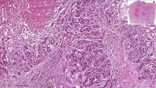 Hepatocellular Carcinoma  Histopathology [upl. by Eissalc]