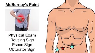 Why there would be Rebound tenderness at the Mcburneys point during Appendicitis [upl. by Seleta]