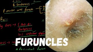 FURUNCLE  Localized Acute Otitis Externa [upl. by Ailic931]