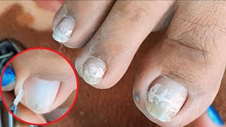 Satisfying Ingrown Toenail Removal  Dry Skin  Pedicure 121 [upl. by Nelram766]