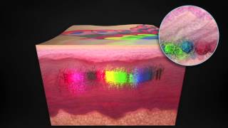 Détatouage au laser Picosure au Centre laser CLIPP à Paris [upl. by Dix]