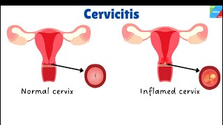 CERVICITIS Types Pathology Clinical features Diagnosis and Treatment DC Dutta [upl. by Jocelin]