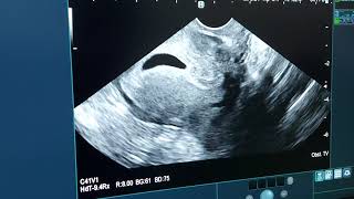 uterus position  anteverted retroflexed  diagnosis by ultrasound  early pregnancy [upl. by Deach]