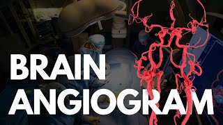 Angiogram  BRAIN angio procedure video [upl. by Sarazen]