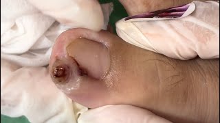 Ep6586 Ingrown toenail removal 👣 อย่าร้องนะคะเดี๋ยวป้าตกใจ 😄 clip from Thailand [upl. by Notla]