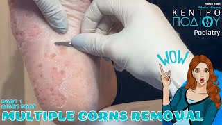 Multiple Corns amp calluses removalΑφαίρεση πολλαπλών κάλωνΠοδιατρικήΚέντρο Ποδιού PodiatryPart 1 [upl. by Nanfa]