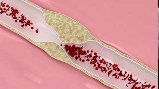 Coronary atherosclerosis animation [upl. by Lossa]