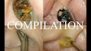 4 CASES  SEVERE EAR  COUGH REFLEX  CERUMEN IMPACTION  FOREIGN BODY  SYNDROMIC EARS [upl. by Nedroj957]