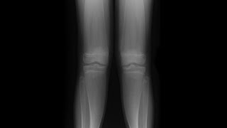 Erlenmyer flask deformity FRCR oral viva [upl. by Laing733]