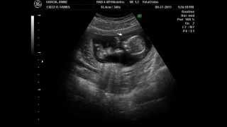 14 week ultrasound Its a Boy [upl. by Tillion]