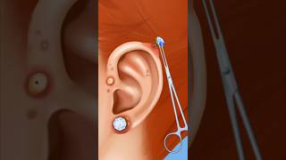 ASMR ear piercing removal Treatment clean ear piercing amp pus 2d animation [upl. by Livingston]