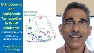 Orthodromic and Antidromic Tachycardias in WPW Syndrome [upl. by Dareg]