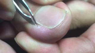 Ingrown Toenail Removal [upl. by Ellenoj123]