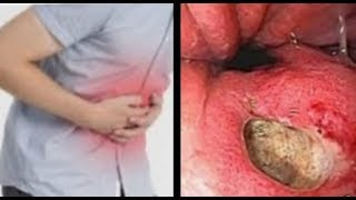 Stomach Ulcer Fast Remedy  How To Relieve Ulcer  Pamax beauty [upl. by Steffen]