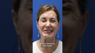 HUGE transformation after selective neurolysis surgery plasticsurgery facialparalysis facialpalsy [upl. by Ytisahc]