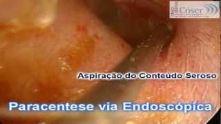 Paracentese Timpânica Endoscópica 2Tympanic Paracentesis Otoendoscopic technique 2 [upl. by Melli]