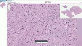 Rosenthal fibers in Pilocytic Astrocytoma  Adventures in Neuropathology [upl. by Nodnarbal524]