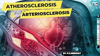 Arteriosclerosis and Atherosclerosis part 1 WITH EASY NOTES  EXPLANATION IN HINDI  NG MEDICALS [upl. by Alber]