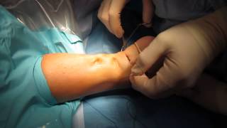 Percutaneous Achilles Tendon Surgery Repair Unedited by Kevin R Stone MD [upl. by Renick]