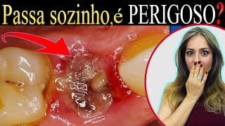 COMO RESOLVER a Alveolite Seca DOR ou Inflamação no LOCAL da Extração de Dente 74 [upl. by Lebasiram]