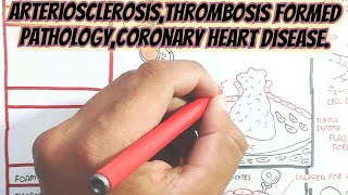 ArteriosclerosisThrombosis Formed PathologyCoronary Heart Disease umerfarooqbiology7083 [upl. by Daveda]