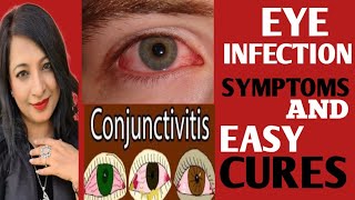 ALARMING RISE OF EYE INFECTIONS SYMPTOMSTYPESMANAGEMENT PRECAUTIONSTREATMENT OF EYE INFECTION [upl. by Eizus]