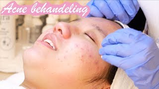 Acne behandeling met peeling [upl. by Ladnor618]