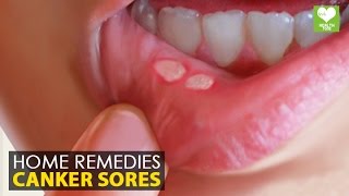 Canker Sores  Home Remedies Natural Treatment  Health Education [upl. by Edijabab436]