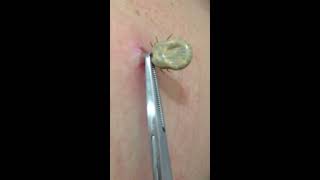 Tick removal by US doctor [upl. by Recha]