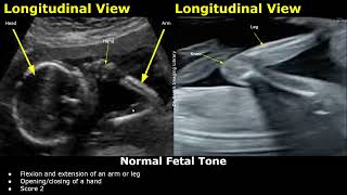 Fetal Biophysical Profile Ultrasound Normal Vs Abnormal Values  Fetus BreathingTone BPSBPP USG [upl. by Linneman]