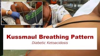 Kussmaul Breathing Pattern [upl. by Magas957]