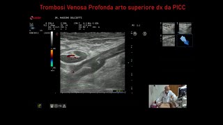 Trombosi Venosa Profonda da PICC al braccio destro [upl. by Ibson555]