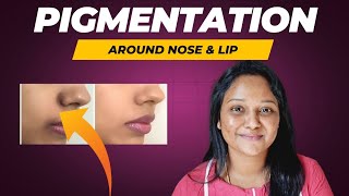 👃Pigmentation in nose corner amp under lips  How to remove pigmentation  Tamil  skincare [upl. by Airolg689]