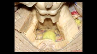 Cerebellopontine Angle and Fourth Ventricle  Part 1 of 2 [upl. by Attoynek]