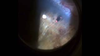 IRIDOTOMIA YAG LASER [upl. by Anehc]