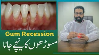 What is gum recession   Can gums grow back   ateeqdentalcare [upl. by Ytrebil]