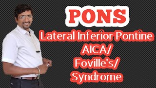 Pons Part  6 Lateral inferior pontine syndrome AICA syndrome Fovilles syndrome [upl. by Lyrrehs]