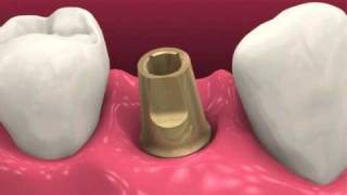 Restoring dental implants video BioHorizons [upl. by Fanya399]