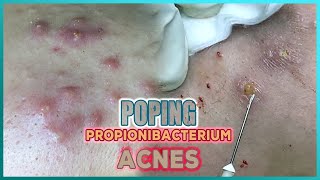 Big Cystic Acne Blackheads Extraction Blackheads amp Milia Whiteheads Removal Pimple Popping [upl. by Enicar617]